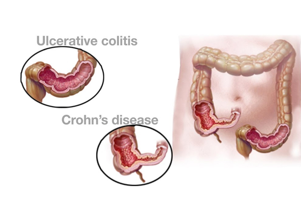 IBD