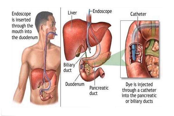 ERCP