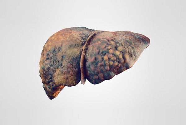 Liver Disease