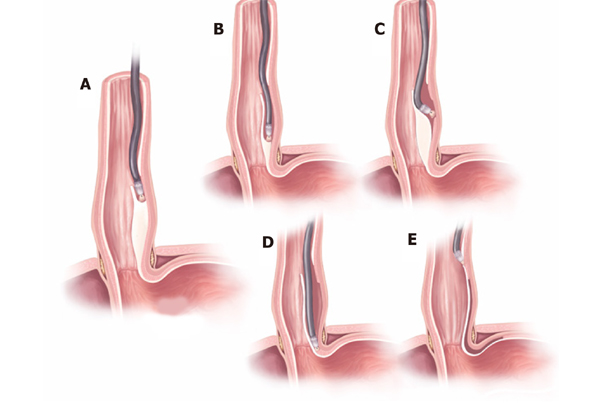 Third Space Endoscopy