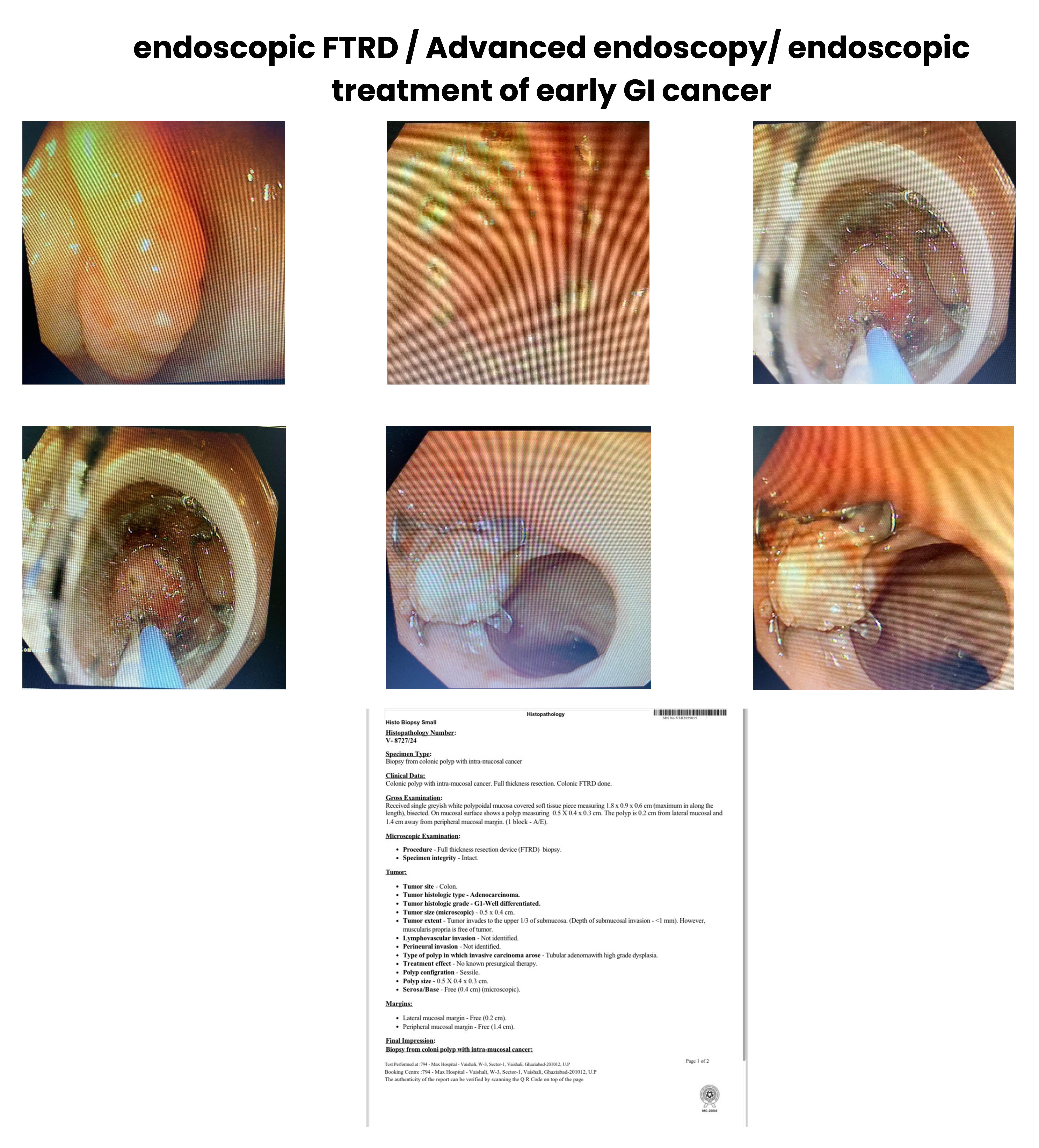 endoscopic FTRD or Advanced endoscopy or endoscopic treatment of early GI cancer