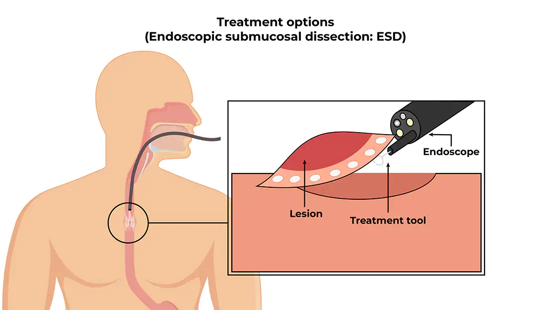 Endoscopic Submucosal Dissection