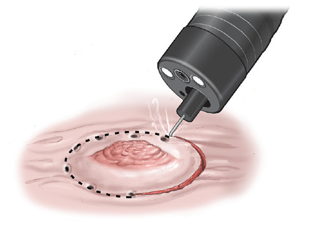 Best Endoscopic Submucosal Dissection