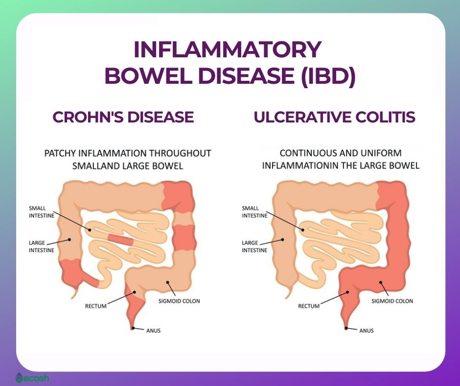 IBD TREATMENT