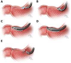 Third Space Endoscopy